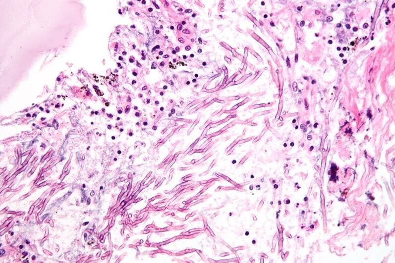 I funghi interrompono il sistema immunitario e portano alla formazione di micosi